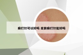 癣打针可以好吗 皮肤癣打针能好吗