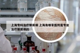 上海专科治疗银屑病 上海有哪家医院是专业治疗银屑病的