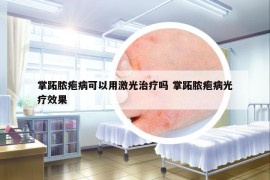 掌跖脓疱病可以用激光治疗吗 掌跖脓疱病光疗效果