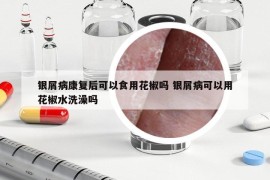 银屑病康复后可以食用花椒吗 银屑病可以用花椒水洗澡吗