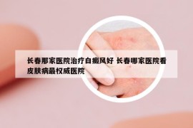 长春那家医院治疗白癜风好 长春哪家医院看皮肤病最权威医院