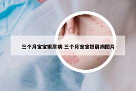 三个月宝宝银屑病 三个月宝宝银屑病图片