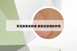 常见藓类皮肤病 癣类皮肤病的种类