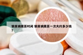 银屑病熏蒸时间 银屑病熏蒸一次大约多少钱?