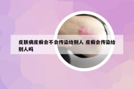皮肤病皮癣会不会传染给别人 皮癣会传染给别人吗