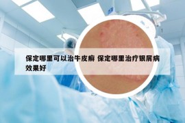 保定哪里可以治牛皮癣 保定哪里治疗银屑病效果好
