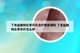 丁克盐酸特比萘芬片治疗银屑病吗 丁克盐酸特比萘芬片怎么样