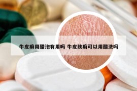 牛皮癣用醋泡有用吗 牛皮肤癣可以用醋洗吗