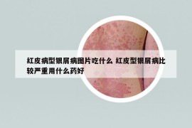 红皮病型银屑病图片吃什么 红皮型银屑病比较严重用什么药好