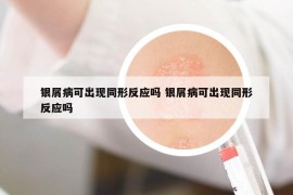 银屑病可出现同形反应吗 银屑病可出现同形反应吗