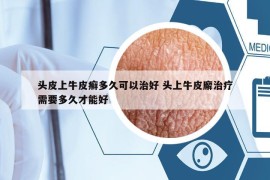 头皮上牛皮癣多久可以治好 头上牛皮廨治疗需要多久才能好