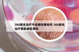 308激光治疗牛皮癣效果如何 308激光治疗银屑病管用吗