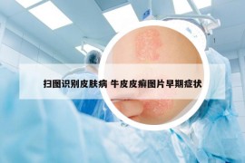扫图识别皮肤病 牛皮皮癣图片早期症状