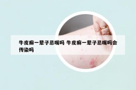 牛皮癣一辈子忌嘴吗 牛皮癣一辈子忌嘴吗会传染吗