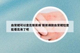 血常规可以查出银屑病 银屑病做血常规检查能看出来了吧