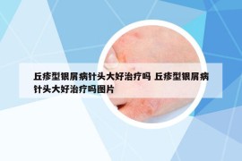 丘疹型银屑病针头大好治疗吗 丘疹型银屑病针头大好治疗吗图片