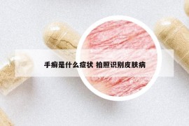 手癣是什么症状 拍照识别皮肤病