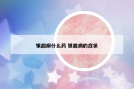 银翘癣什么药 银翘病的症状