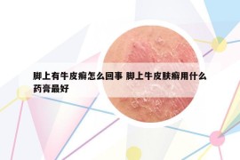脚上有牛皮癣怎么回事 脚上牛皮肤癣用什么药膏最好