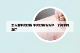 怎么治牛皮肤癣 牛皮肤癣告诉你一个简单的治疗
