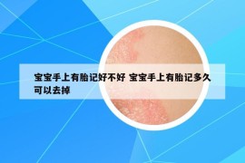 宝宝手上有胎记好不好 宝宝手上有胎记多久可以去掉