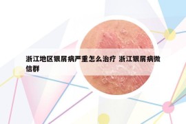浙江地区银屑病严重怎么治疗 浙江银屑病微信群