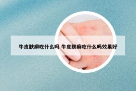 牛皮肤癣吃什么吗 牛皮肤癣吃什么吗效果好