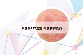 牛皮癣217洗剂 牛皮肤癣洗药