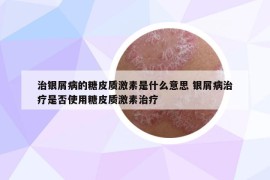 治银屑病的糖皮质激素是什么意思 银屑病治疗是否使用糖皮质激素治疗