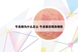 牛皮癣为什么忌口 牛皮癣忌嘴有哪些