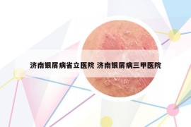 济南银屑病省立医院 济南银屑病三甲医院