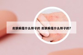 皮肤癣是什么样子的 皮肤癣是什么样子的?