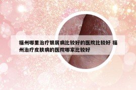 福州哪里治疗银屑病比较好的医院比较好 福州治疗皮肤病的医院哪家比较好