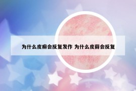 为什么皮癣会反复发作 为什么皮藓会反复