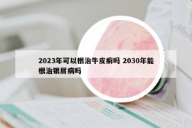 2023年可以根治牛皮癣吗 2030年能根治银屑病吗