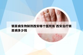 银屑病生物制剂西安哪个医院有 西安治疗银屑病多少钱