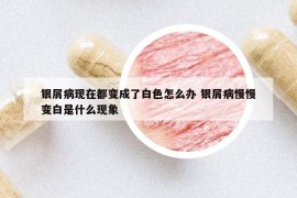 银屑病现在都变成了白色怎么办 银屑病慢慢变白是什么现象