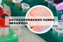 女孩子来月经后银屑病会复发吗 月经期银屑病都会加重变红吗