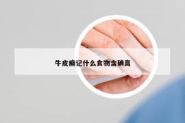 牛皮癣记什么食物含碘高