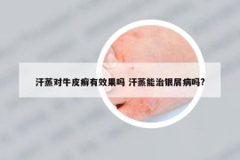 汗蒸对牛皮癣有效果吗 汗蒸能治银屑病吗?