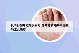 扎耳钉会导致牛皮癣吗 扎耳钉会导致牛皮癣吗怎么治疗