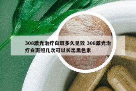 308激光治疗白斑多久见效 308激光治疗白斑照几次可以长出黑色素