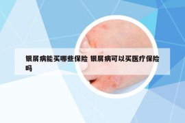 银屑病能买哪些保险 银屑病可以买医疗保险吗