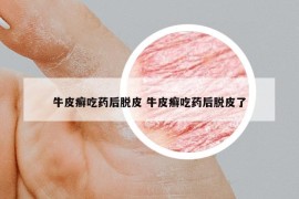 牛皮癣吃药后脱皮 牛皮癣吃药后脱皮了