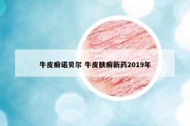 牛皮癣诺贝尔 牛皮肤癣新药2019年