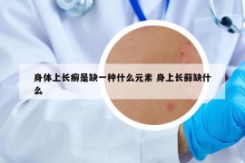 身体上长癣是缺一种什么元素 身上长藓缺什么