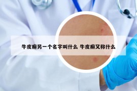 牛皮癣另一个名字叫什么 牛皮癣又称什么