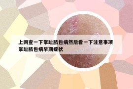 上网查一下掌趾脓包病然后看一下注意事项 掌趾脓包病早期症状