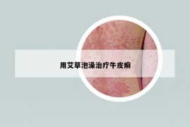 用艾草泡澡治疗牛皮癣