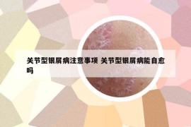 关节型银屑病注意事项 关节型银屑病能自愈吗